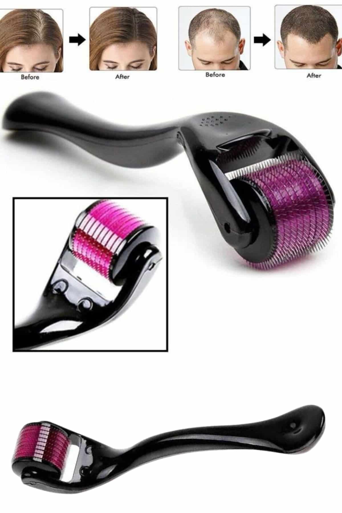 Derma Roller Titanyum Uçlu 540 İğneli 1 Mm Saç Sakal Çıkarma Ve Cilt Bakım Masaj Aleti 3